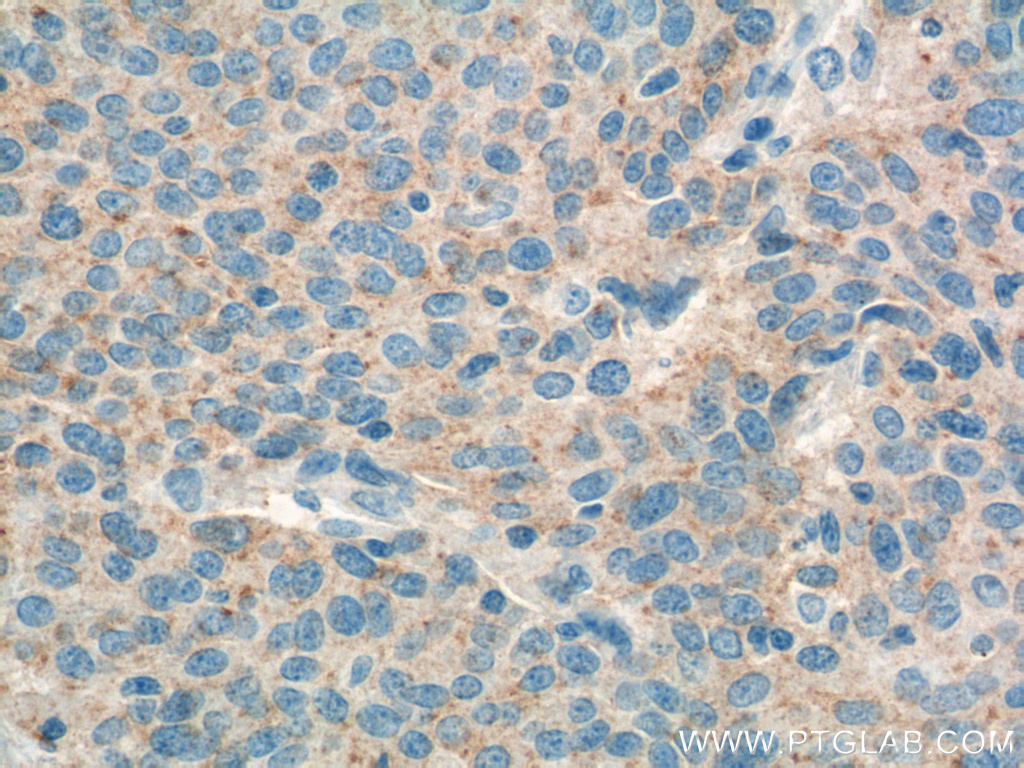IHC staining of human lung cancer using 66314-1-Ig (same clone as 66314-1-PBS)