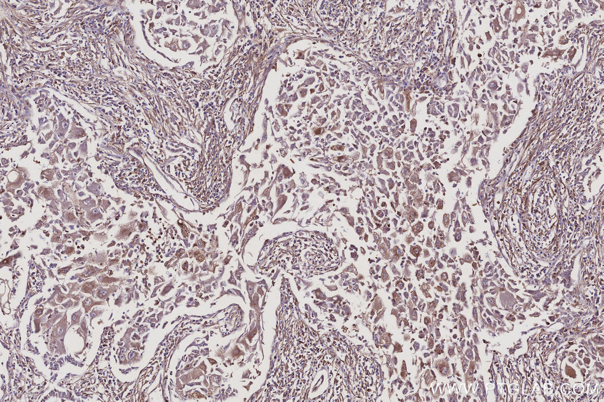 IHC staining of human lung cancer using 10950-1-AP