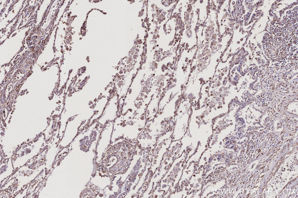 IHC staining of human lung cancer using 10950-1-AP