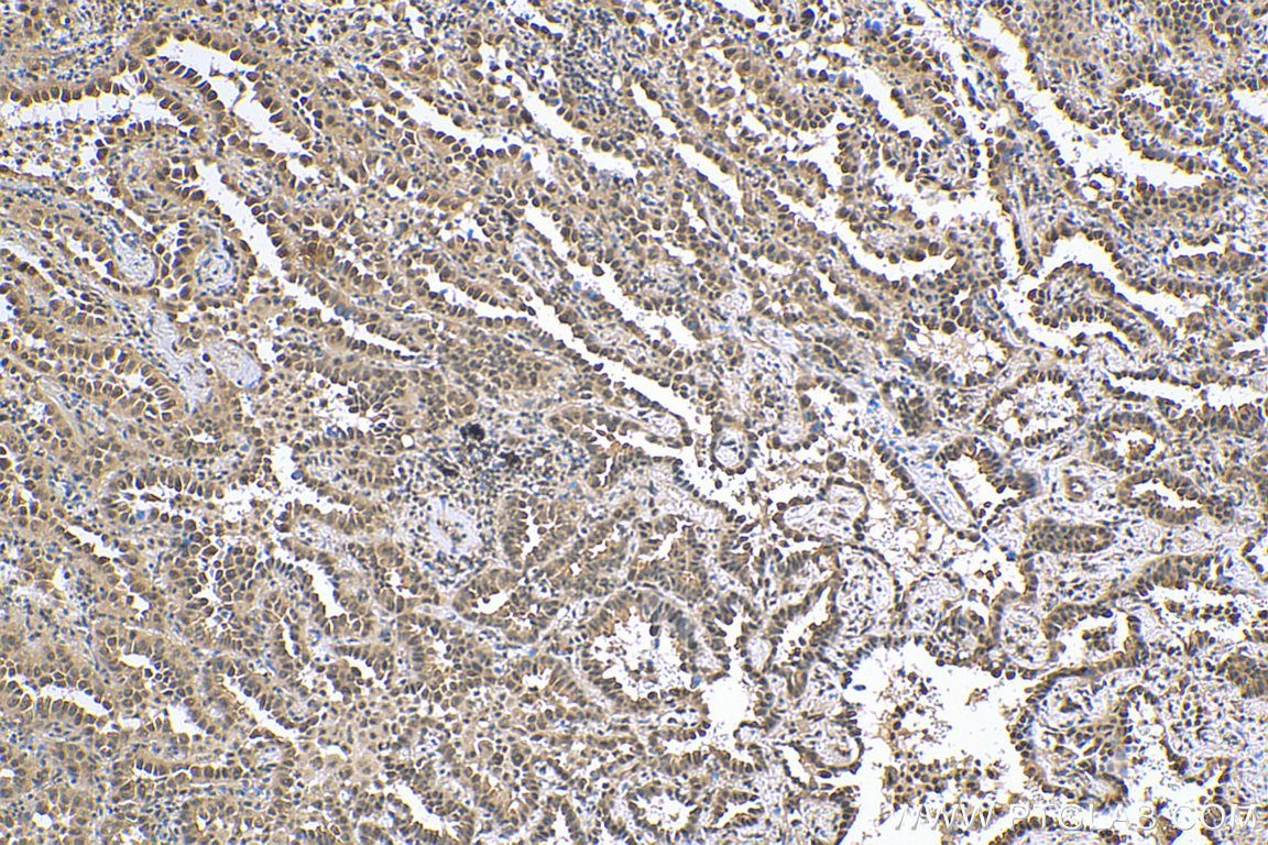 IHC staining of human lung cancer using 67851-1-Ig