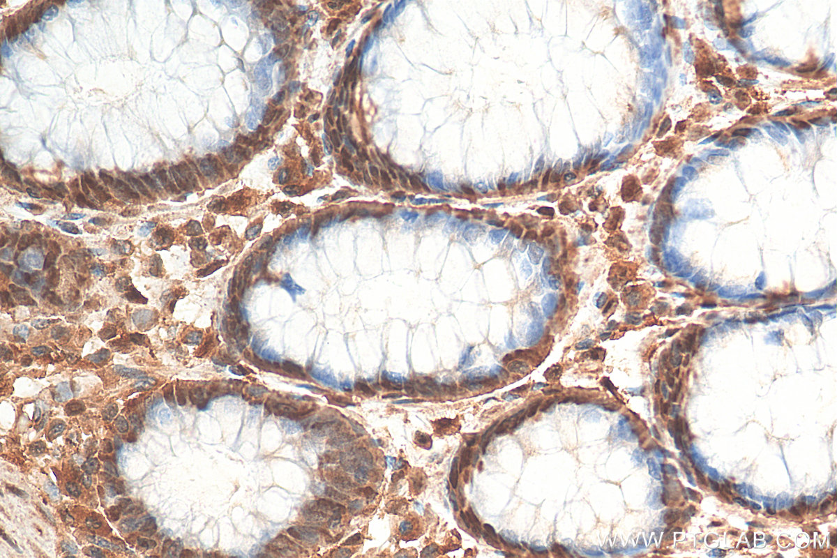 IHC staining of human colon cancer using 14684-1-AP