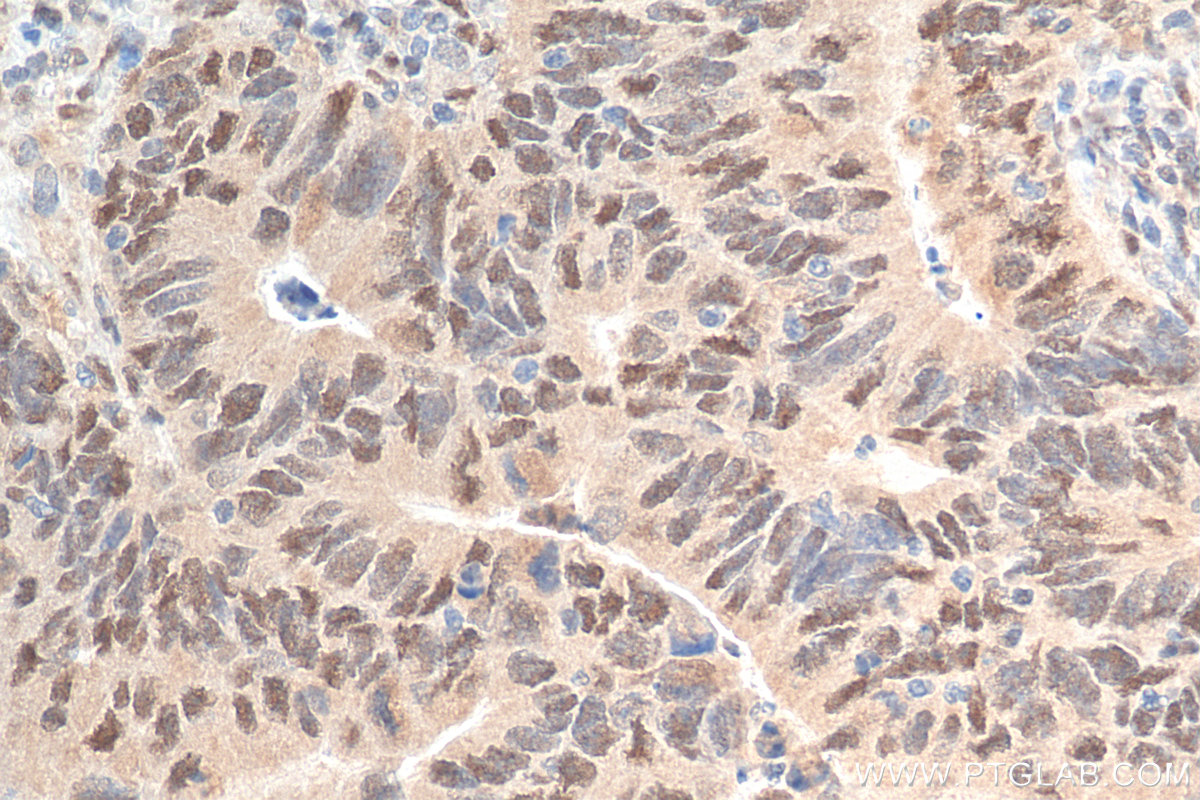 IHC staining of human colon cancer using 14684-1-AP