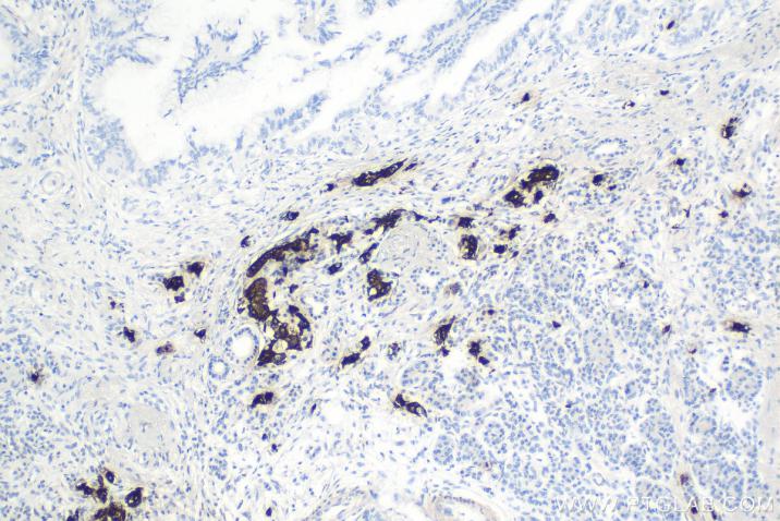 使用 Proteintech 的 Insulin 小鼠单克隆抗体 (66198-1-Ig) 和抗小鼠/兔通用型免疫组化检测试剂盒 (PK10006) 对人胰腺癌组织进行免疫组织化学分析。