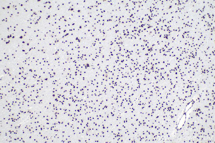使用 Proteintech 的 TDP-43 兔重组抗体 (80001-1-RR) 和抗兔免疫组化检测试剂盒 (PK10009) 对人脑胶质瘤组织进行免疫组织化学分析。