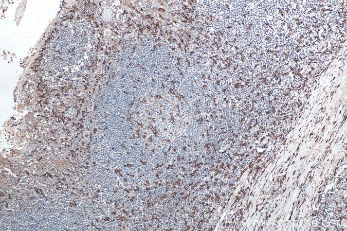 使用 Proteintech 的 IBA1 兔多克隆抗体 (10904-1-Ap) 和抗兔免疫组化检测试剂盒 (PK10009) 对人扁桃体炎组织进行免疫组织化学分析。