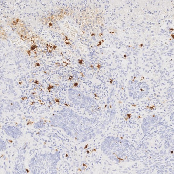 IHC staining of human skin cancer using 82271-8-RR IHC staining of human skin cancer using 82271-8-RR