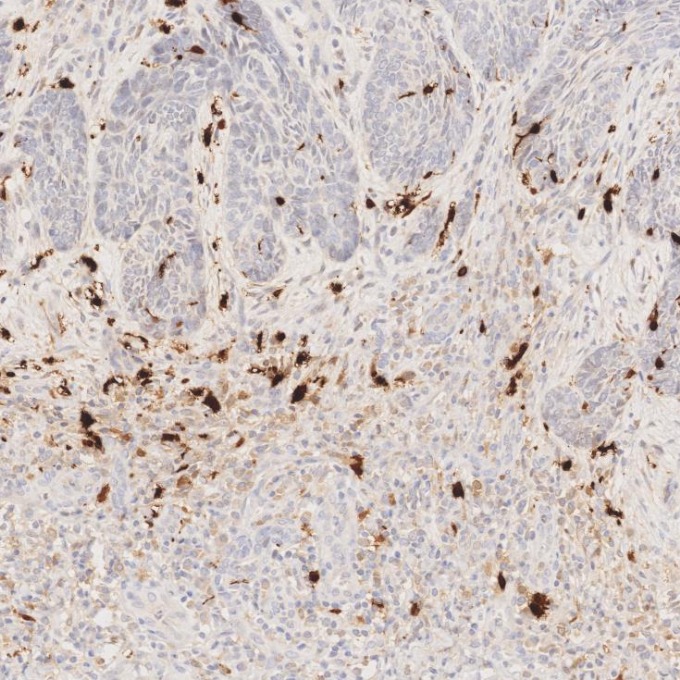 IHC staining of human skin cancer using 82271-8-RR IHC staining of human skin cancer using 82271-8-RR
