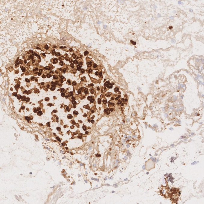 IHC staining of human malignant melanoma using 82271-8-RR IHC staining of human malignant melanoma using 82271-8-RR