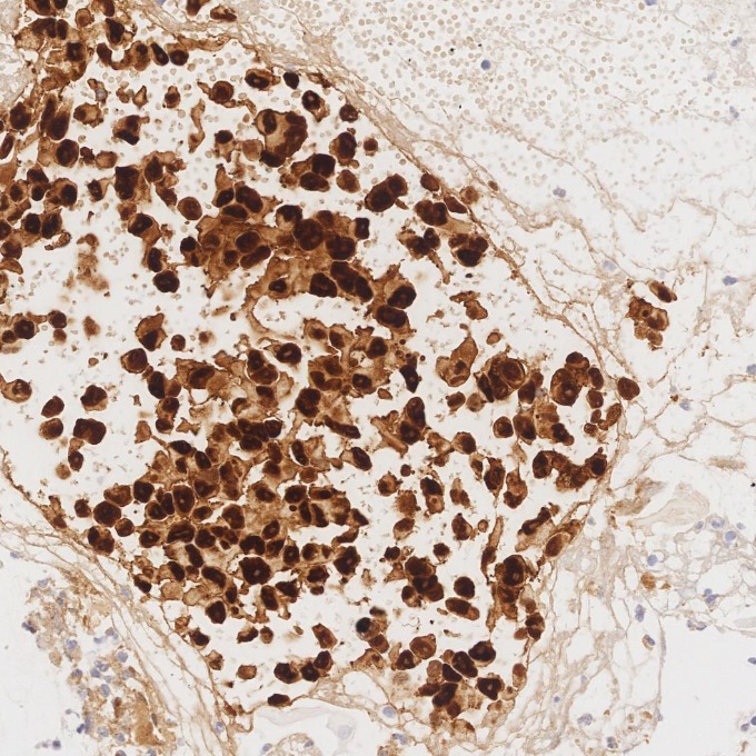 IHC staining of human malignant melanoma using 82271-8-RR IHC staining of human malignant melanoma using 82271-8-RR