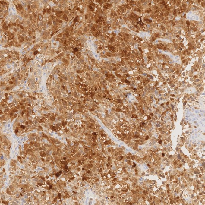 IHC staining of human malignant melanoma using 82271-8-RR IHC staining of human malignant melanoma using 82271-8-RR