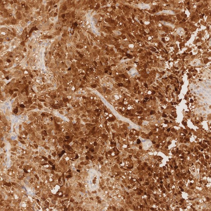 IHC staining of human malignant melanoma using 82271-8-RR IHC staining of human malignant melanoma using 82271-8-RR