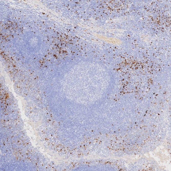 IHC staining of human tonsillitis using 82271-8-RR IHC staining of human tonsillitis using 82271-8-RR