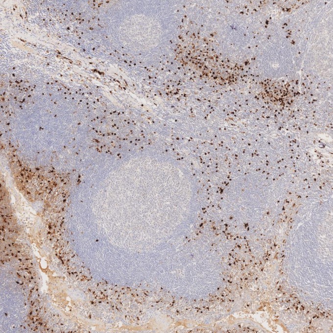 IHC staining of human tonsillitis using 82271-8-RR IHC staining of human tonsillitis using 82271-8-RR