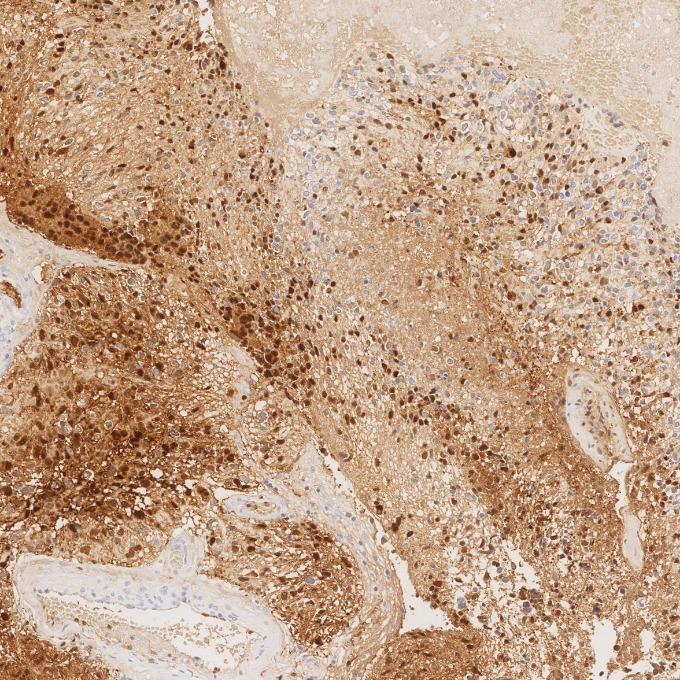 IHC staining of human gliomas using 82271-8-RR IHC staining of human gliomas using 82271-8-RR