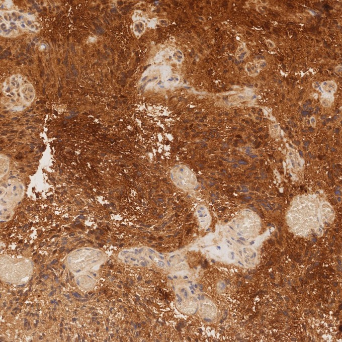 IHC staining of human gliomas using 82271-8-RR IHC staining of human gliomas using 82271-8-RR