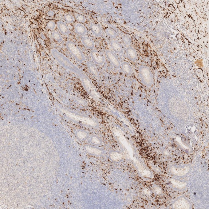 IHC staining of human appendicitis using 82271-8-RR IHC staining of human appendicitis using 82271-8-RR
