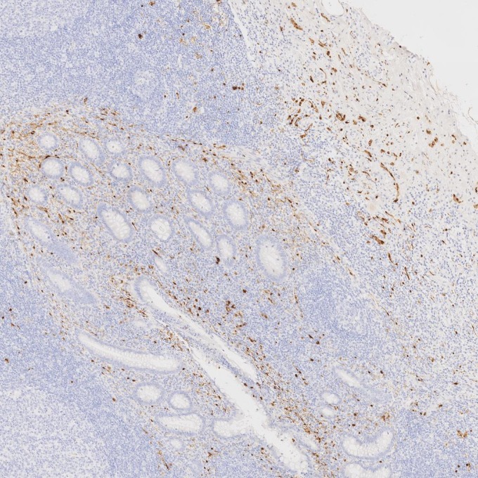 IHC staining of human appendicitis using 82271-8-RR IHC staining of human appendicitis using 82271-8-RR