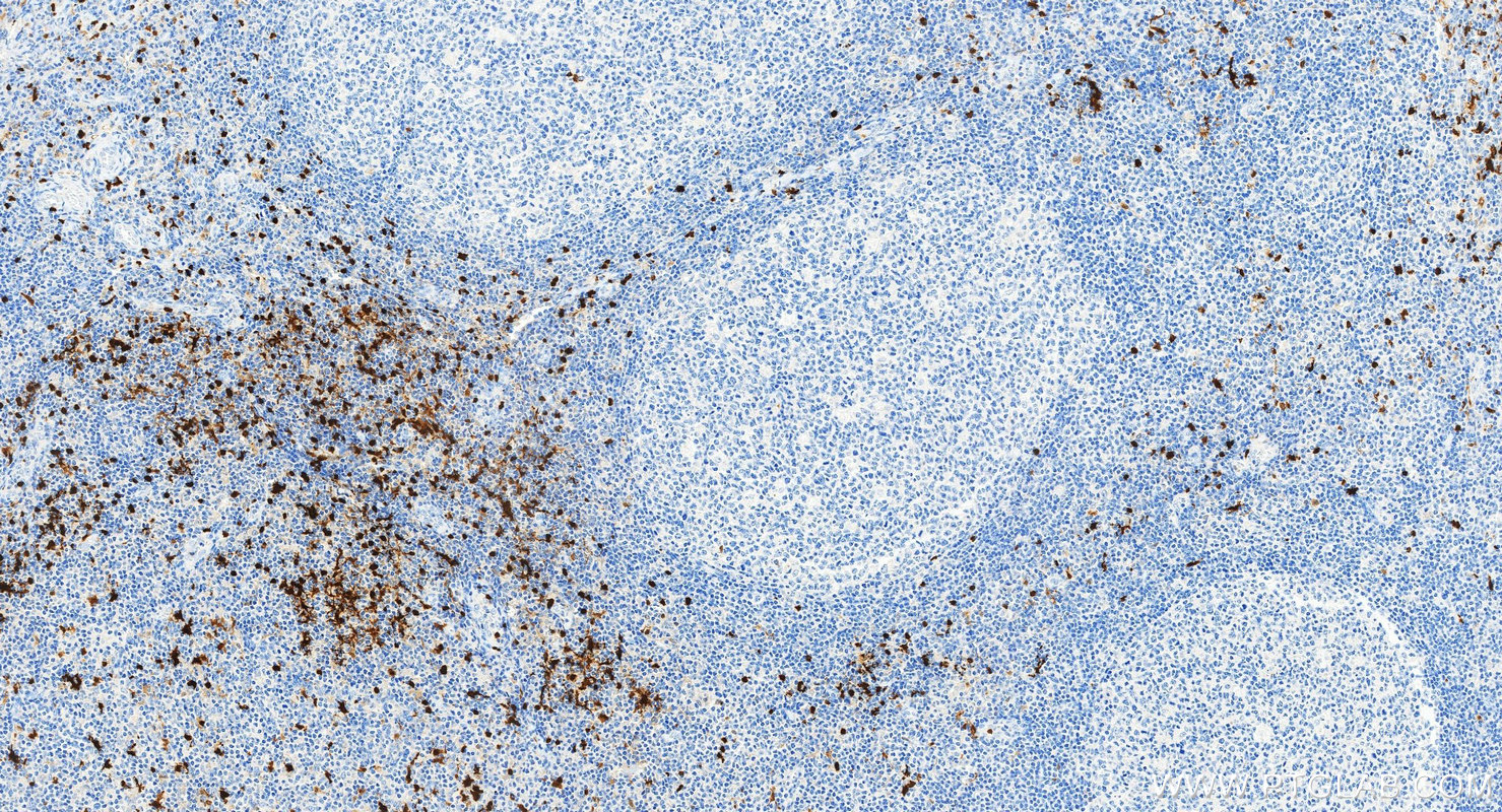 IHC staining of human tonsillitis using 82271-8-RR IHC staining of human tonsillitis using 82271-8-RR