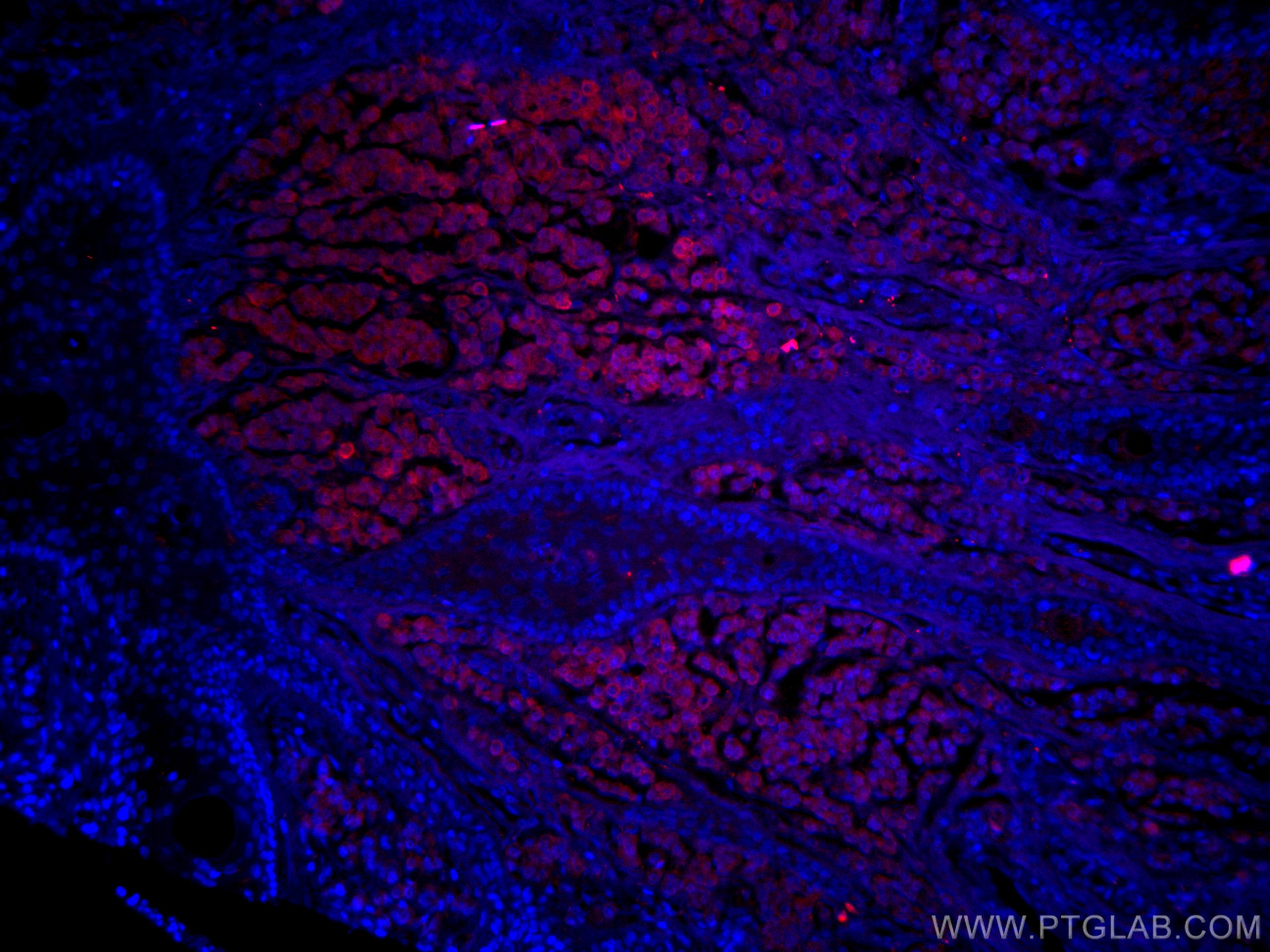 IF Staining of human malignant melanoma using CL594-15146