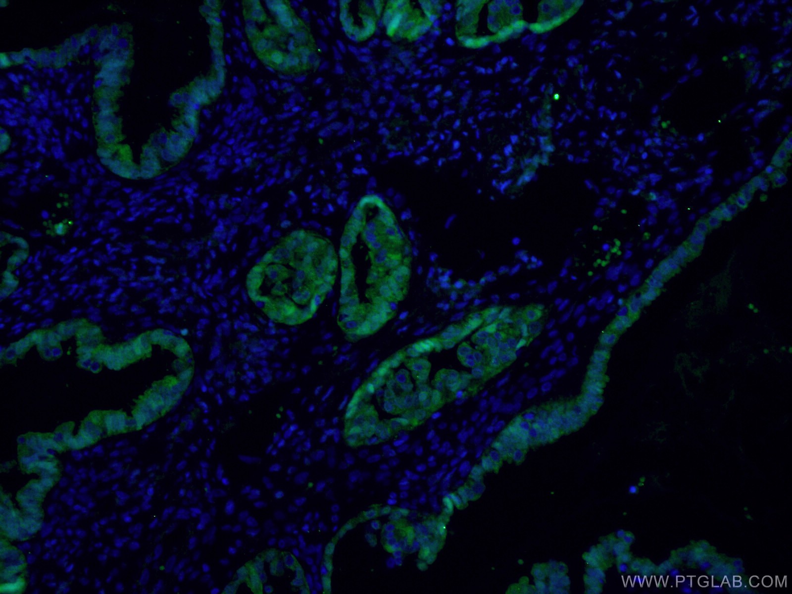 IF Staining of human ovary cancer using 16027-1-AP