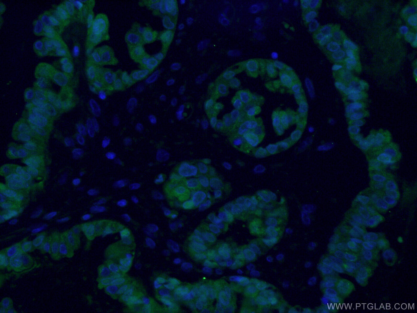IF Staining of human ovary cancer using 16027-1-AP