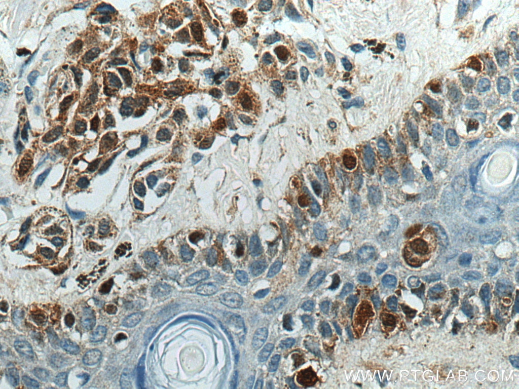 IHC staining of human malignant melanoma using 16027-1-AP