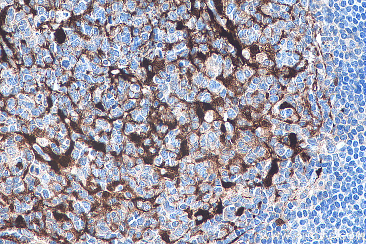 IHC staining of human tonsillitis using 67237-1-Ig