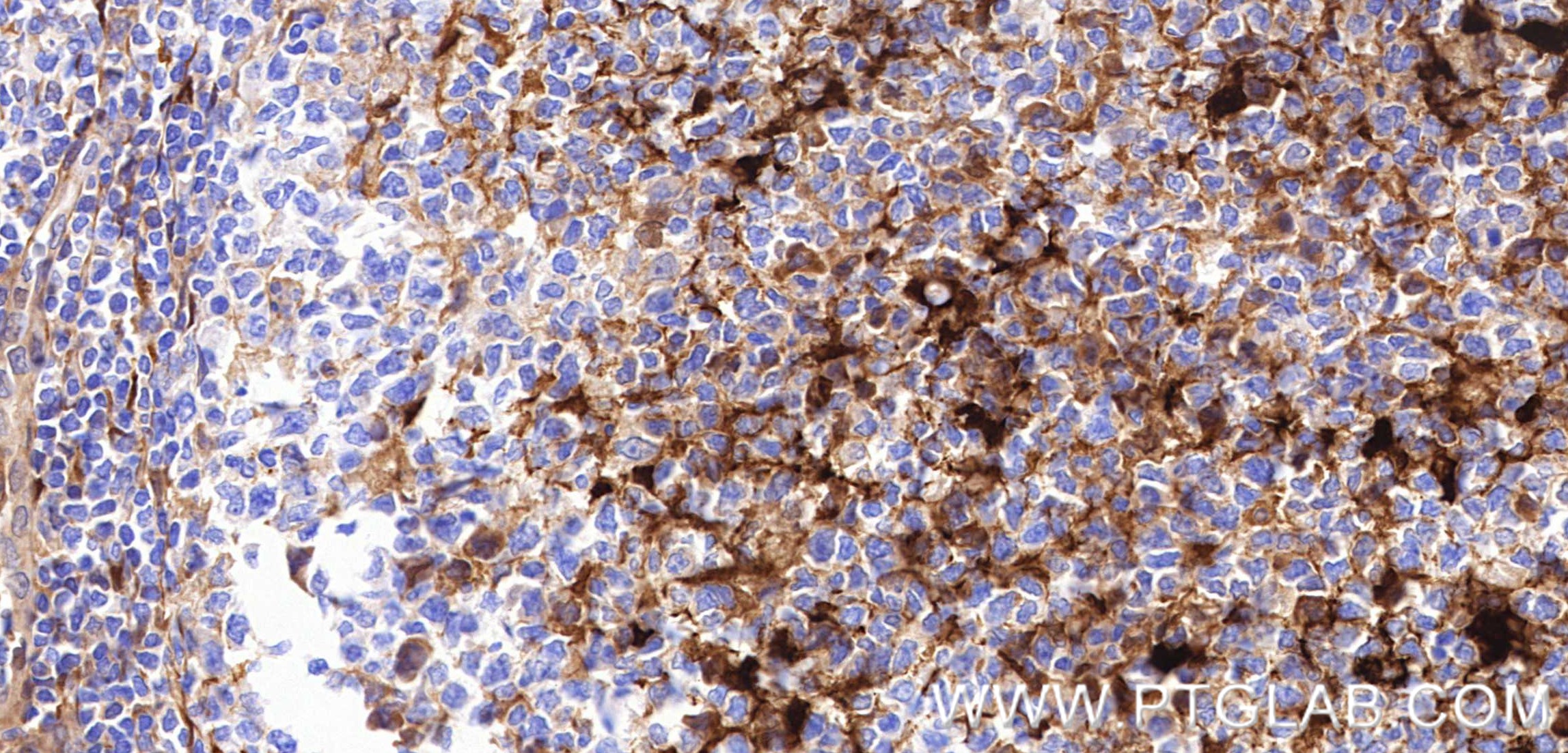 IHC staining of human tonsillitis using 88164-1-RR (same clone as 88164-1-PBS) IHC staining of human tonsillitis using 88164-1-RR (same clone as 88164-1-PBS)