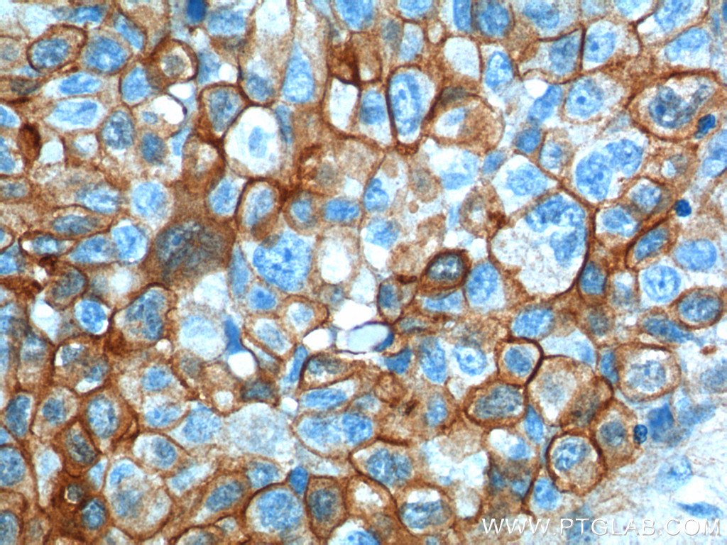 IHC staining of human lung cancer using 11250-1-AP