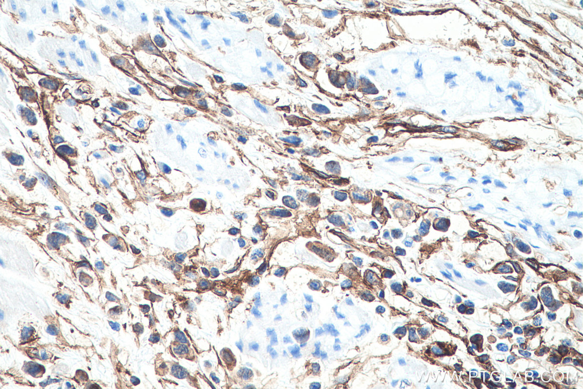 IHC staining of human stomach cancer using 66227-1-Ig