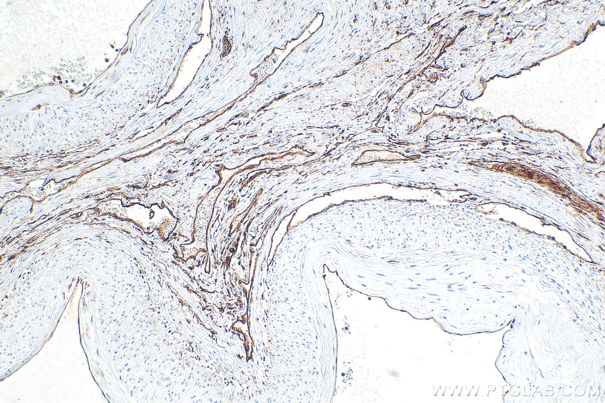IHC staining of human cervical cancer using 66227-1-Ig (same clone as 66227-1-PBS)