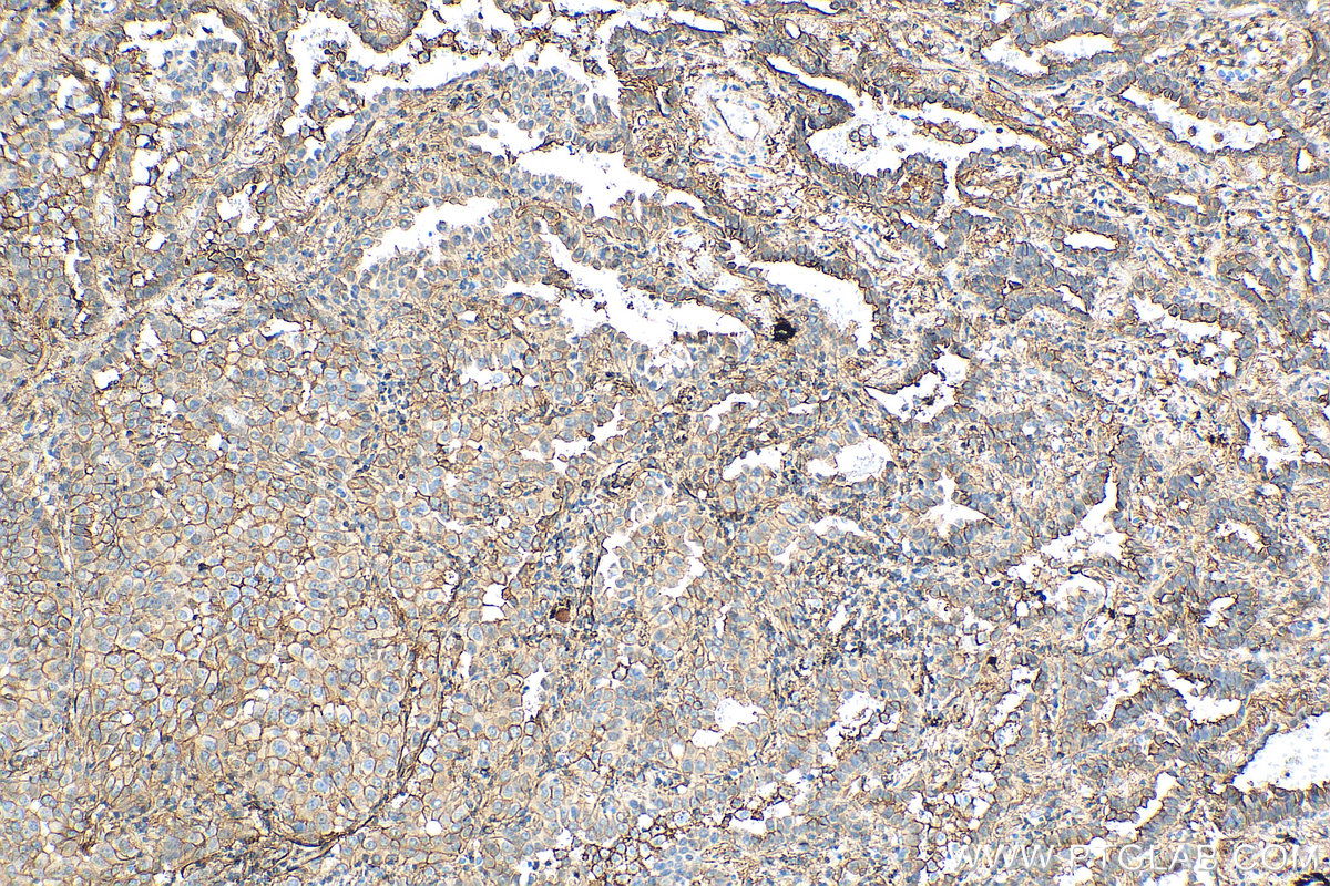 IHC staining of human lung cancer using 81017-1-RR (same clone as 81017-1-PBS)