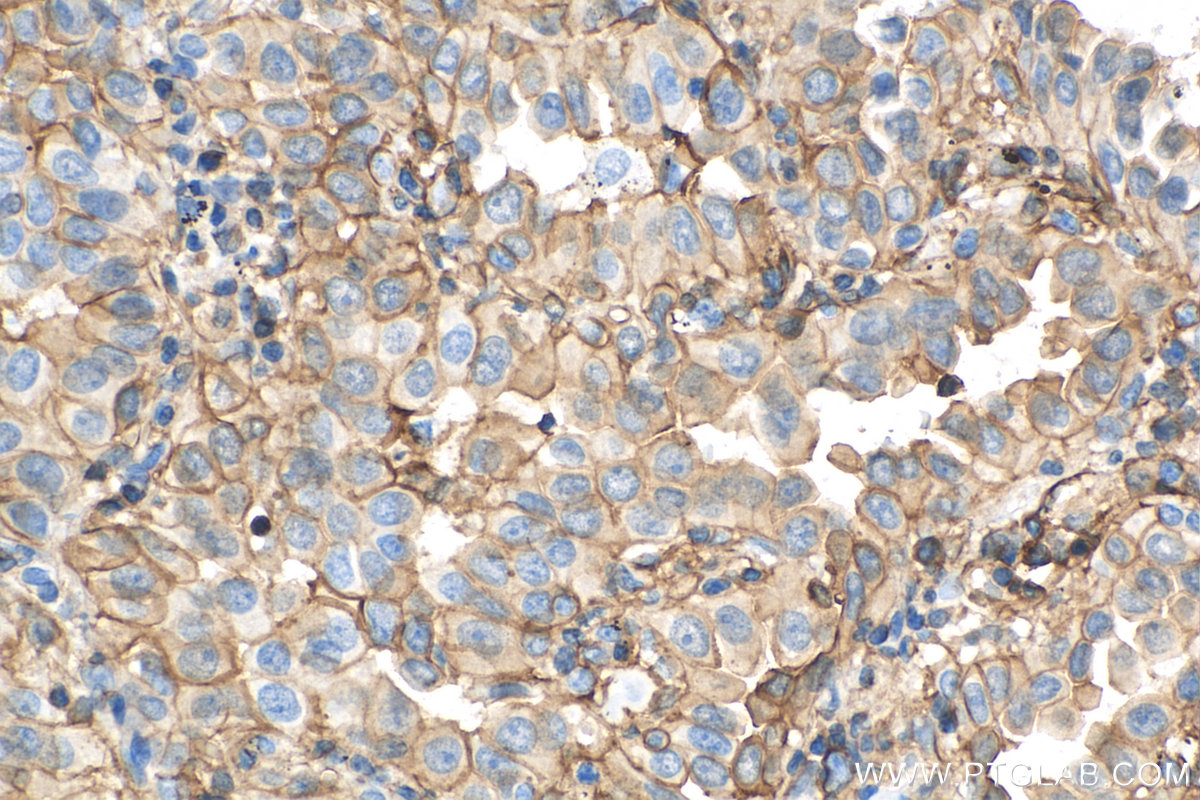 IHC staining of human lung cancer using 81017-1-RR (same clone as 81017-1-PBS)