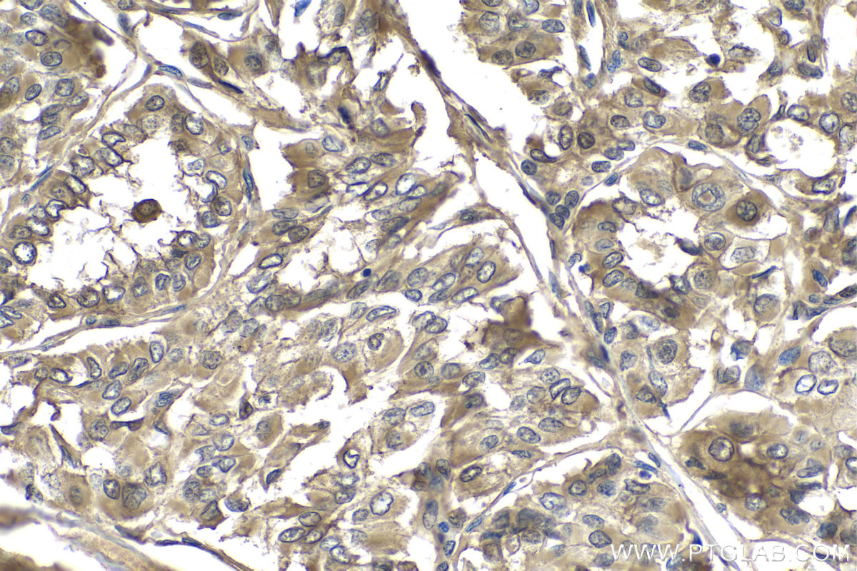 IHC staining of human thyroid cancer using 10237-1-AP