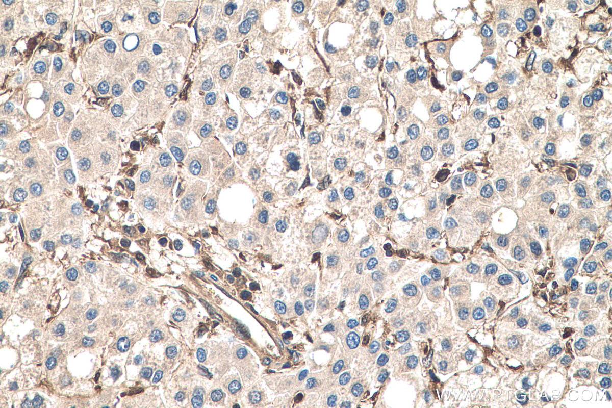 IHC staining of human liver cancer using 10237-1-AP