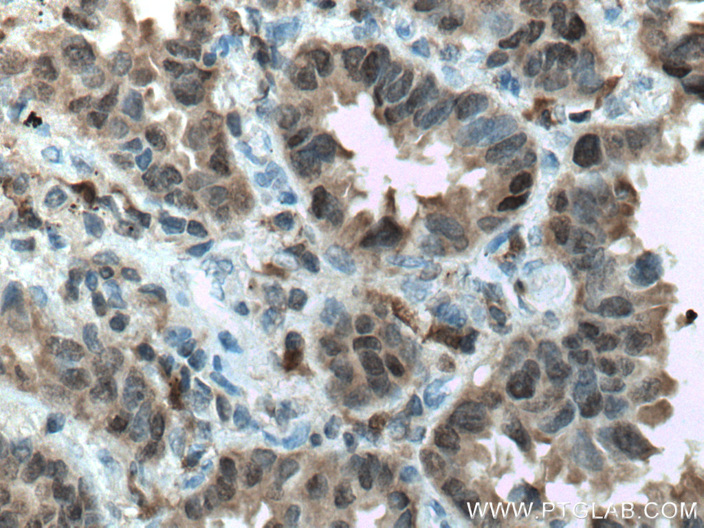 IHC staining of human lung cancer using 60024-1-Ig