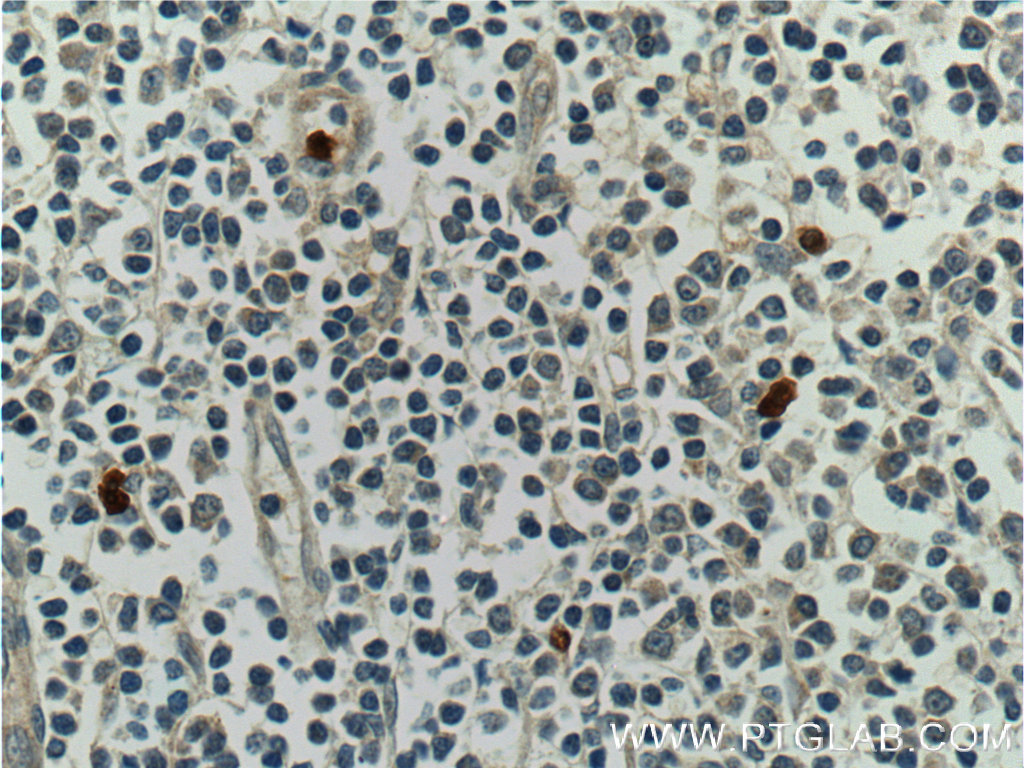 IHC staining of human tonsillitis using 16630-1-AP