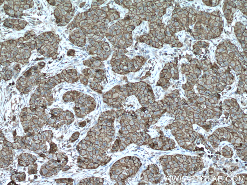 IHC staining of human breast cancer using 10489-1-AP