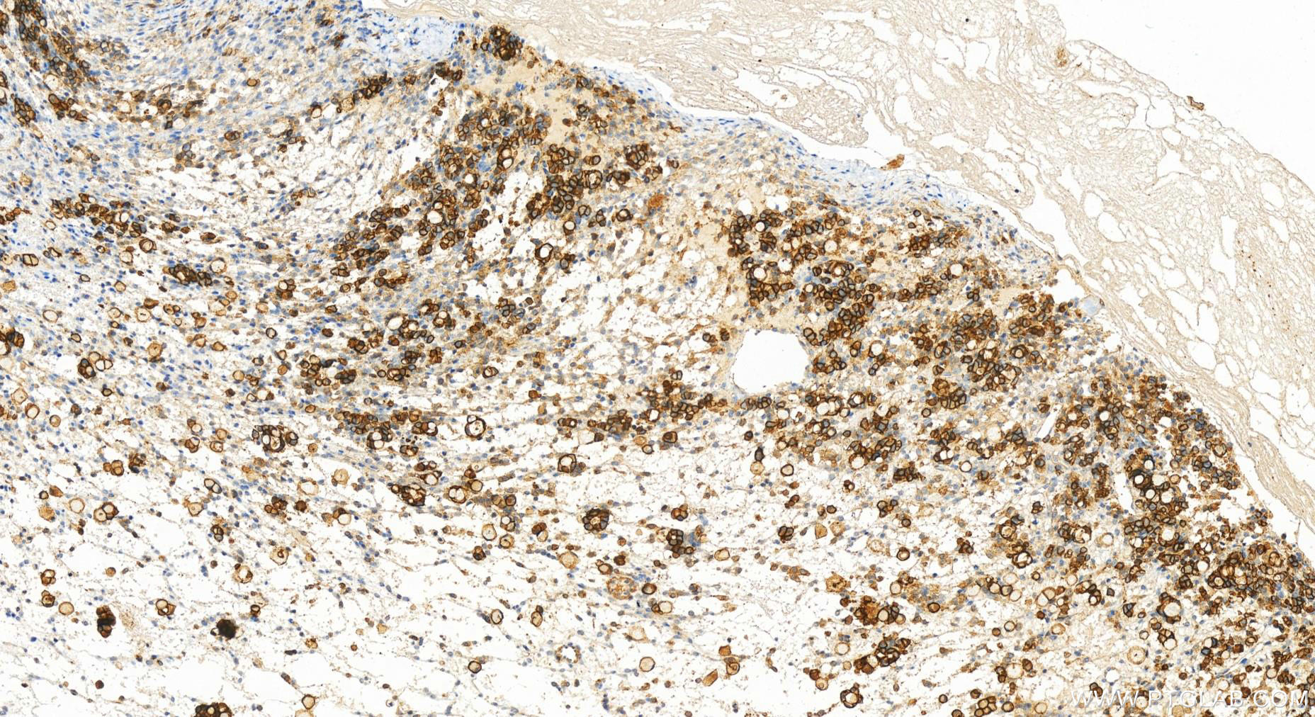IHC staining of human ovary cancer using 83559-5-RR (same clone as 83559-5-PBS)