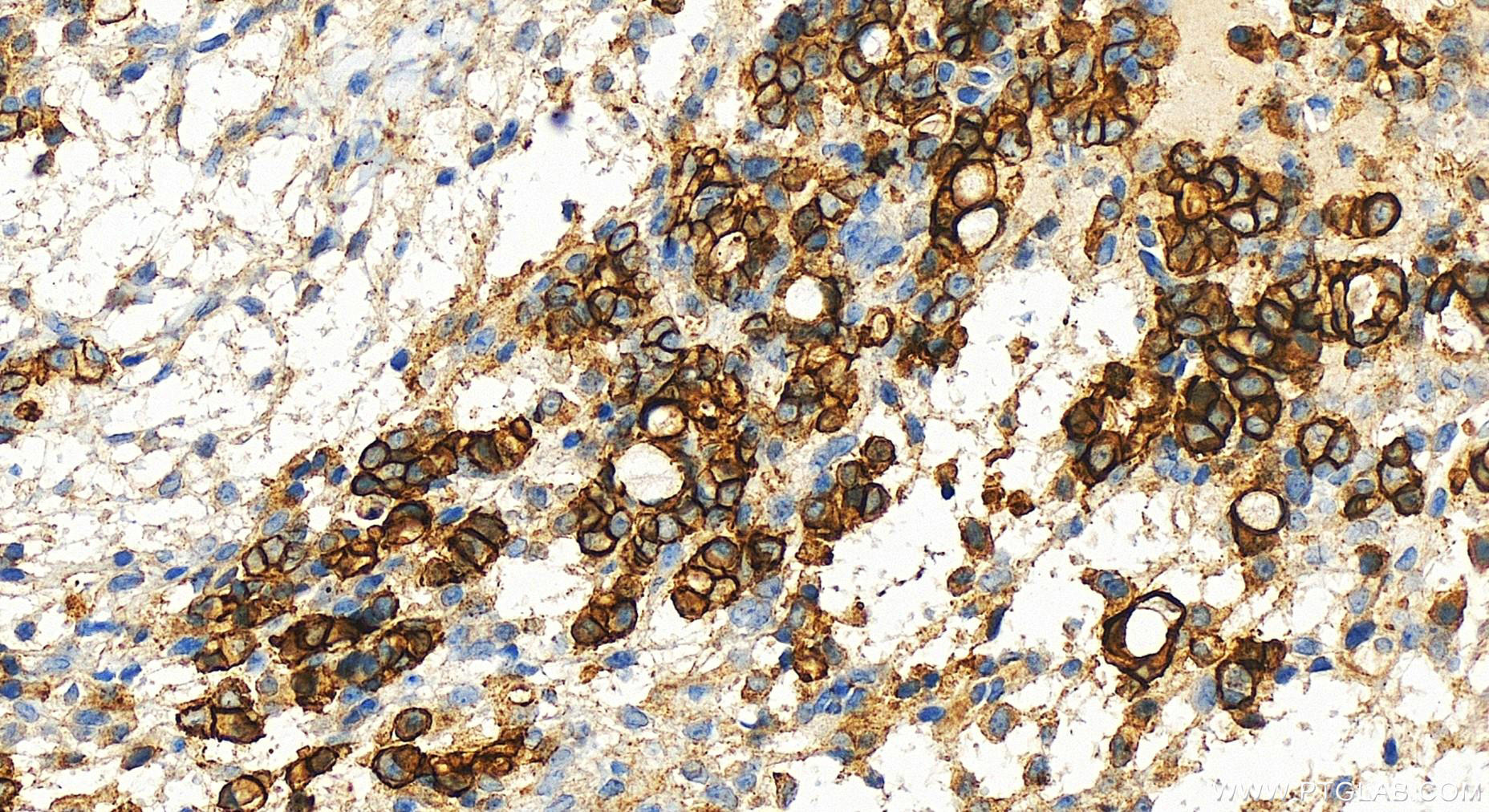 IHC staining of human ovary cancer using 83559-5-RR (same clone as 83559-5-PBS)