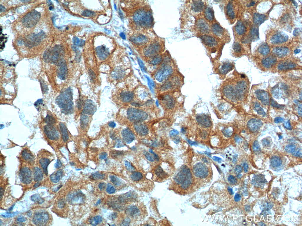 IHC staining of human lung cancer using 11456-1-AP