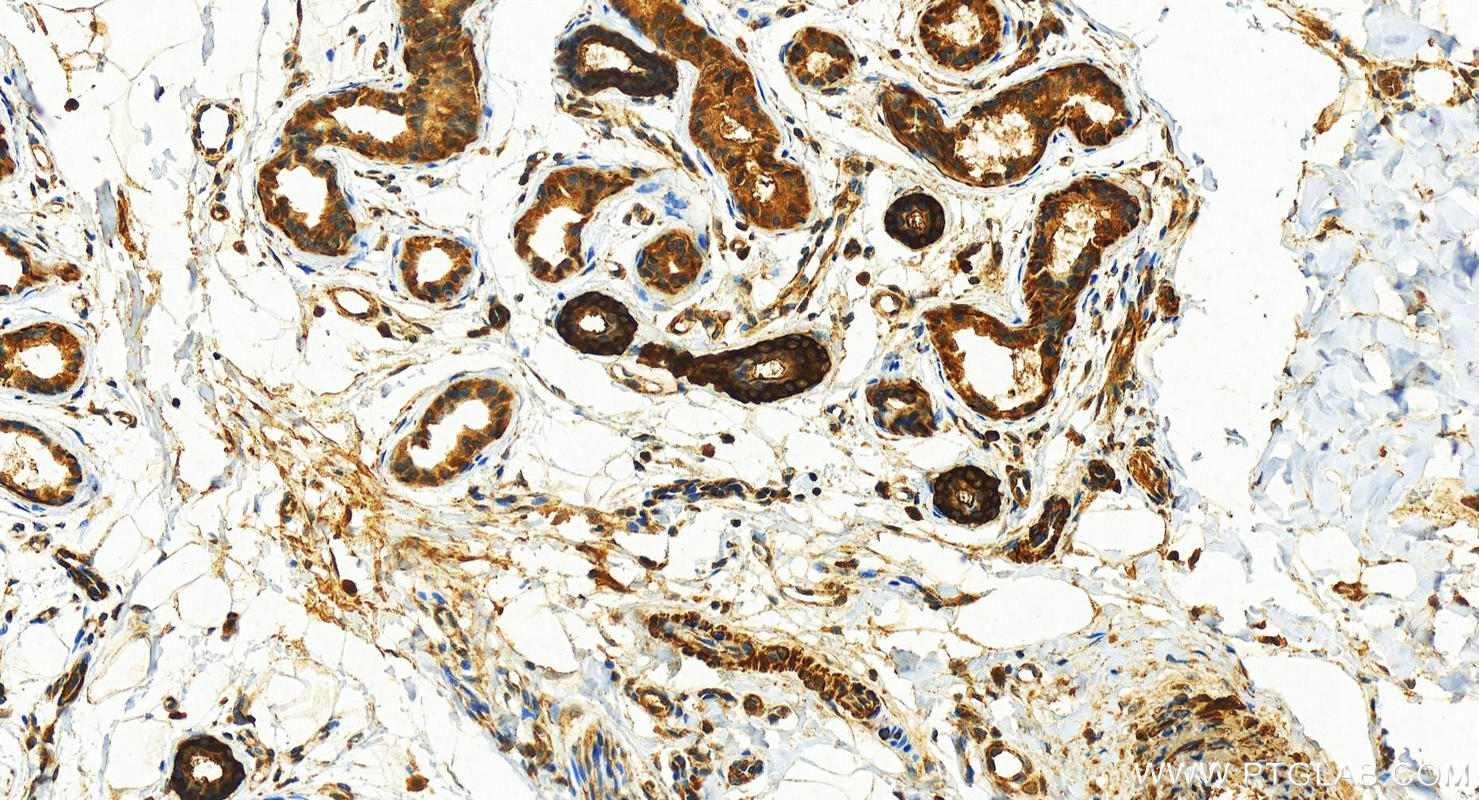 IHC staining of human bowen disease using 15454-1-AP