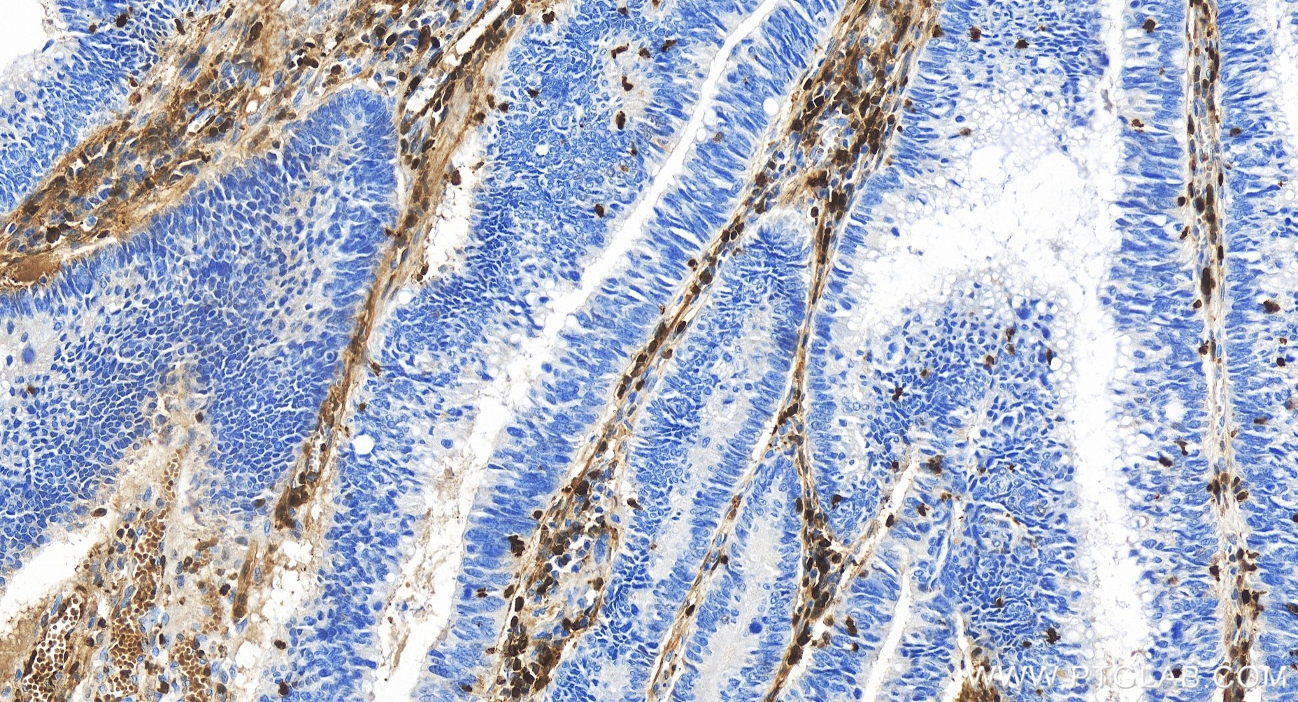 IHC staining of human colon cancer using 84221-1-RR