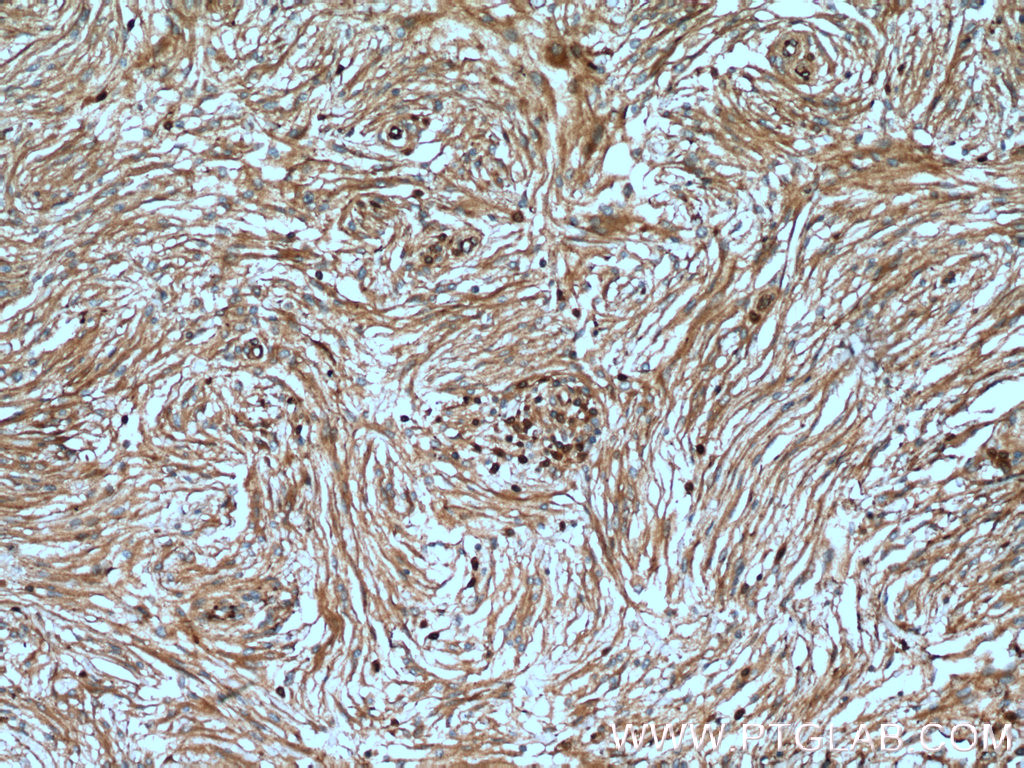 IHC staining of human meningioma using 17924-1-AP