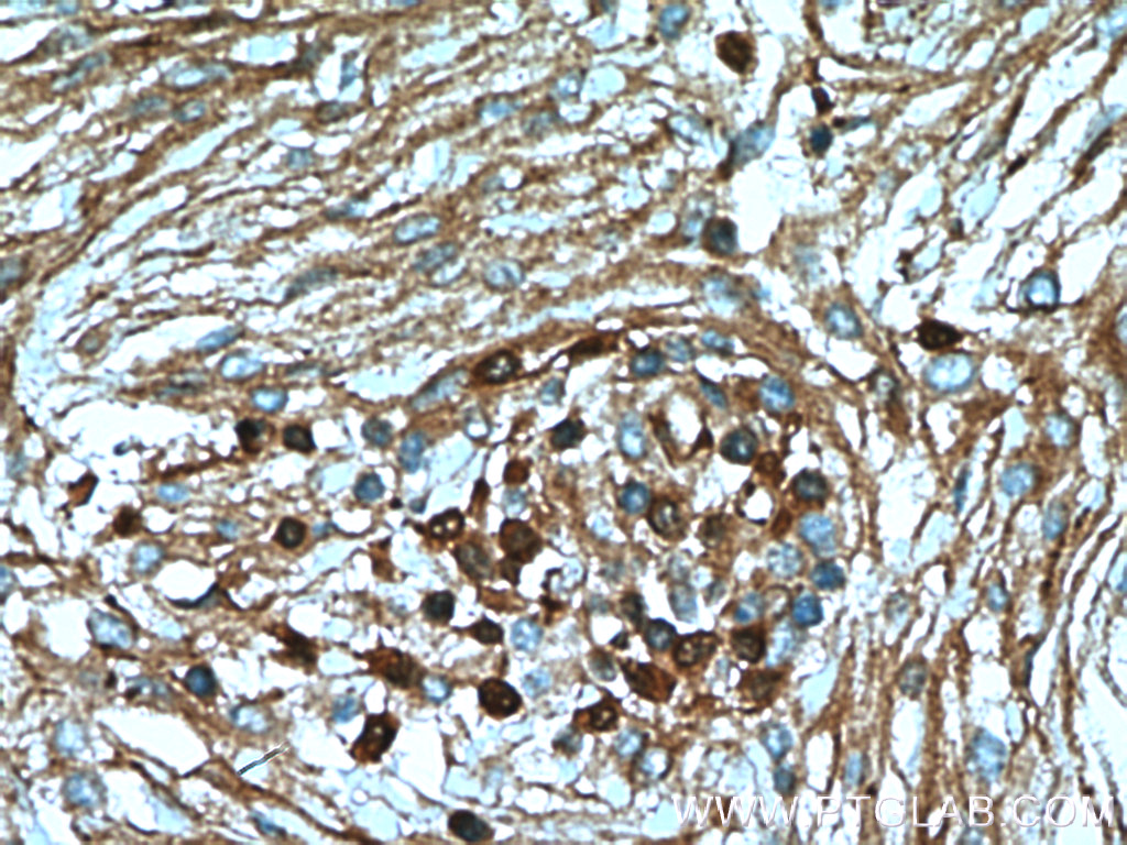 IHC staining of human meningioma using 17924-1-AP