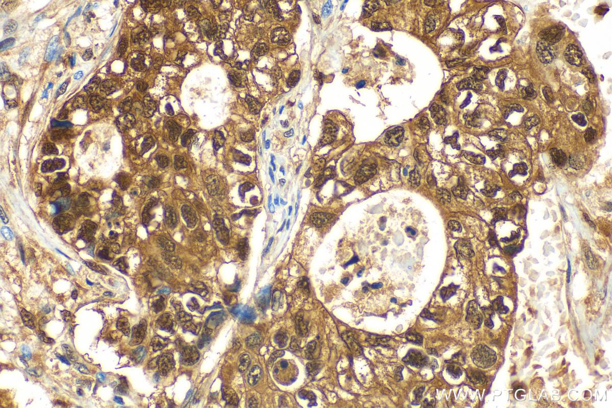 IHC staining of human stomach cancer using 10245-1-AP