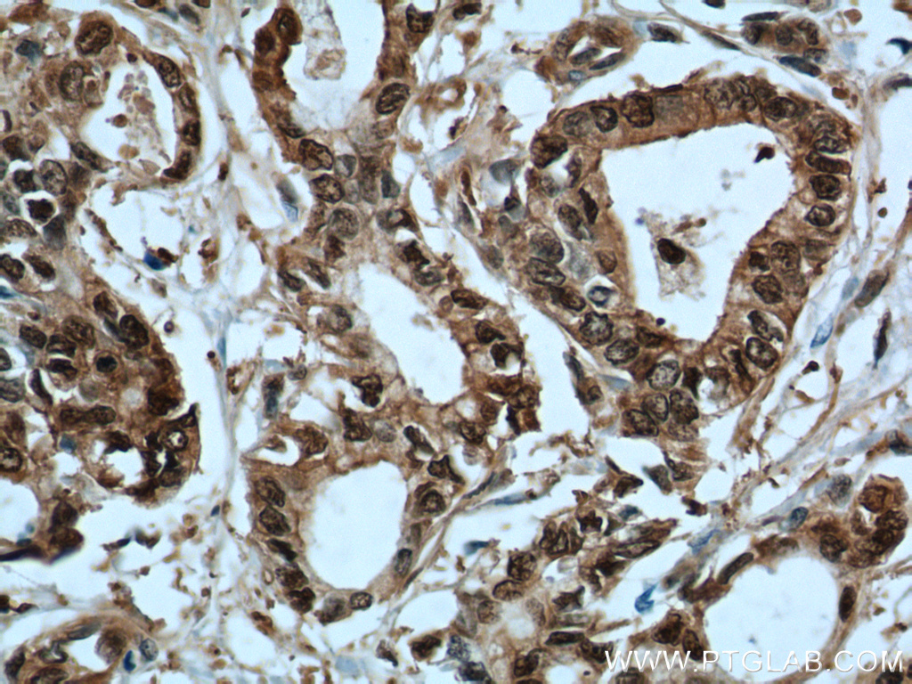 IHC staining of human pancreas cancer using 10245-1-AP