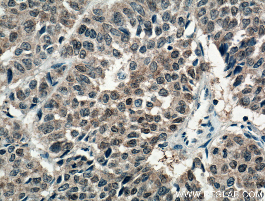 IHC staining of human colon cancer using 66098-1-Ig (same clone as 66098-1-PBS)