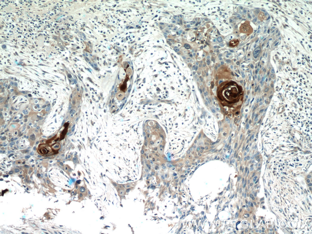 IHC staining of human oesophagus cancer using 13061-1-AP (same clone as 13061-1-PBS)