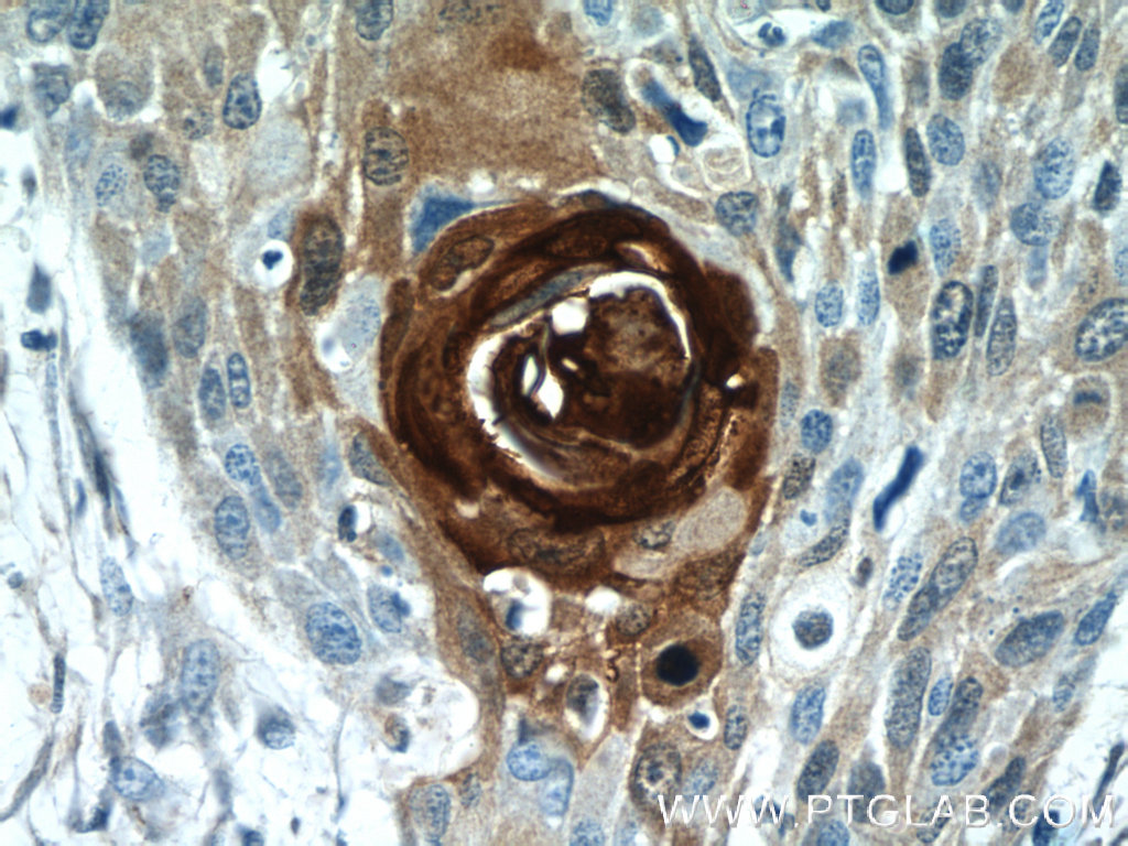 IHC staining of human oesophagus cancer using 13061-1-AP (same clone as 13061-1-PBS)